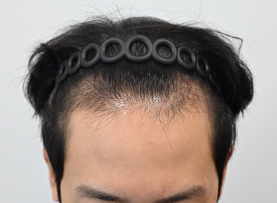 이식전정면.png