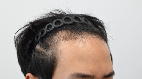 모발이식측면1.png