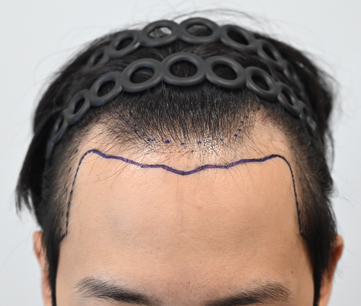 모발이식후 정면.png