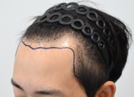 모발이식후 측면.png