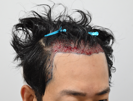 모발당일3.png