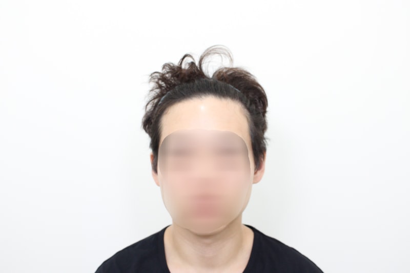 6개월차 모발이식 후기