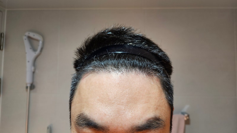 모아트 비절개 모발이식 4개월차 후기 680모낭
