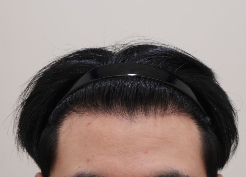 3. 수술후_1년_1.JPG