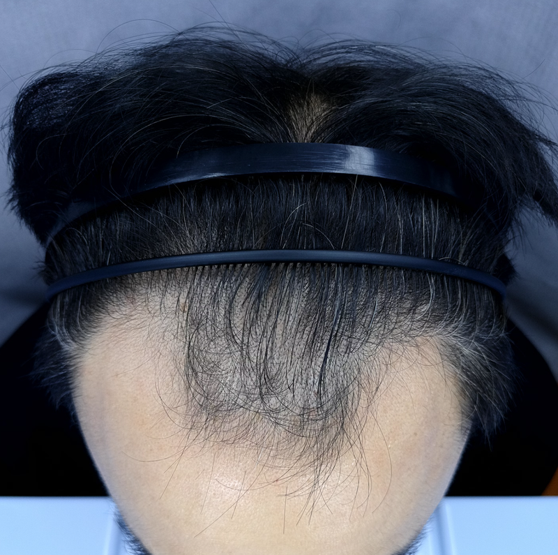 오재영78 이식전 머리띠 아프스.png