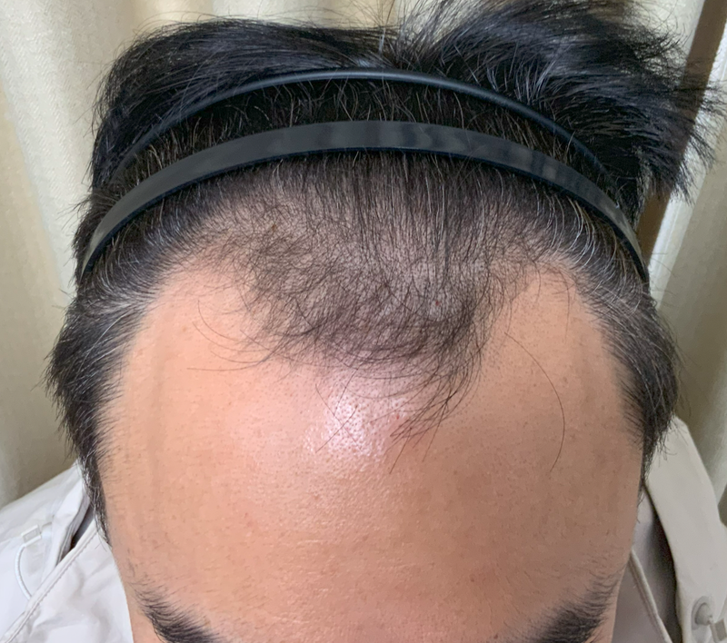 오재영78 이식전 머리띠.png
