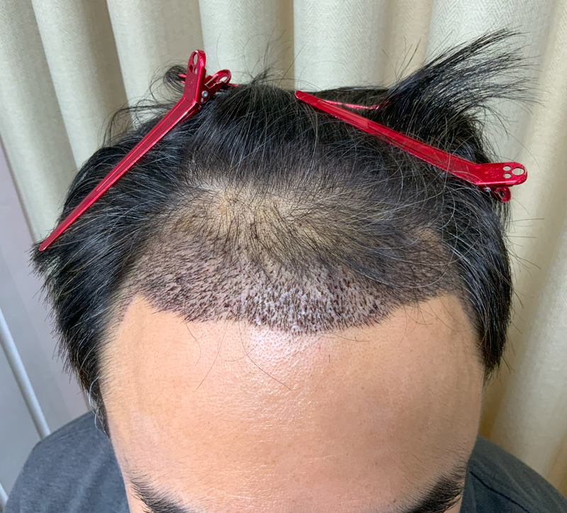 오재영78 이식후 머리띠.png
