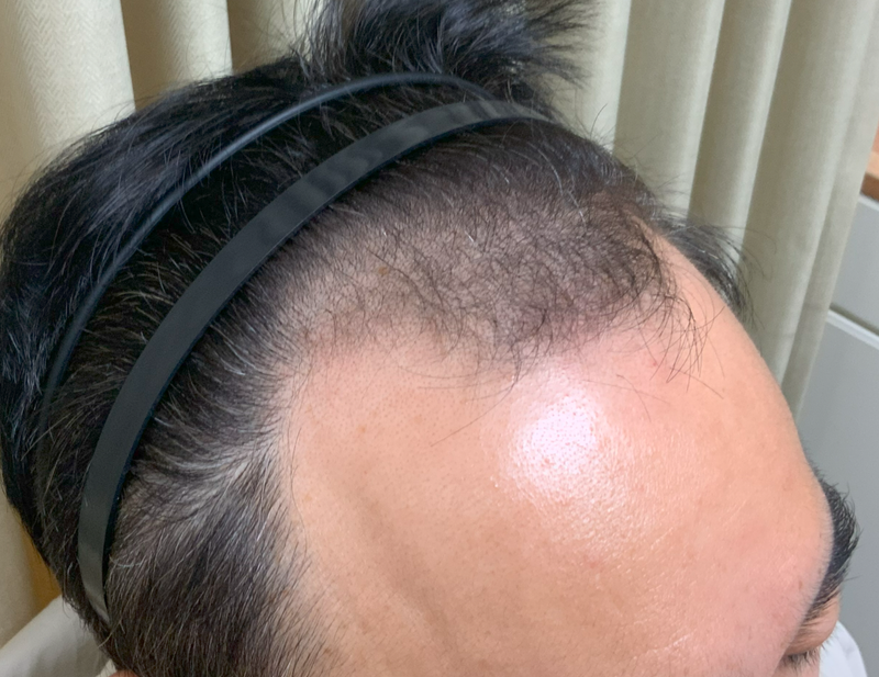 오재영78 이식전 측면.png