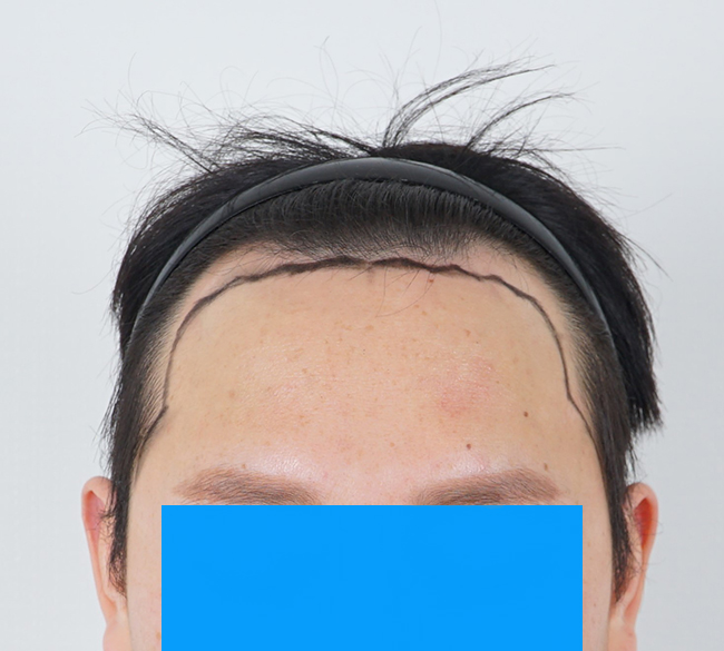 부산모발이식병원 모모 부산점 고상진원장님께 수술받고 1년이 지났습니다(절개 2400모)