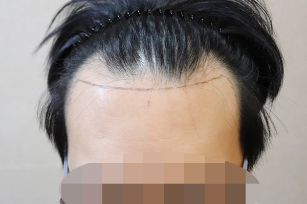 I planted 3,500 at JP Hair Transplant Clinic as a deep M-shaped + hairline non-cut.