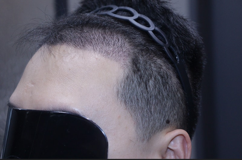 광주 압구정모비앙의원 모발이식 2주 경과 후기