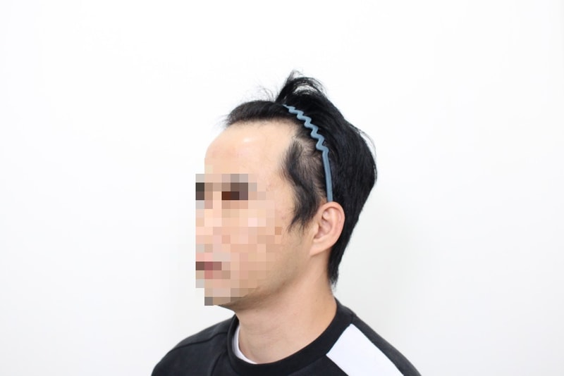 모프로의원 M자 절개+줄기세포 6개월경과