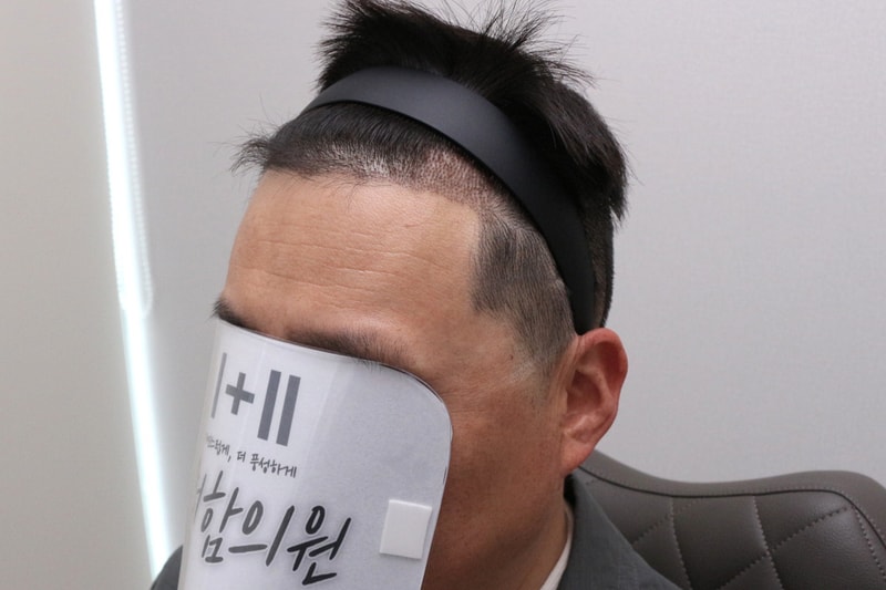 모발이식수술 10일차 후기입니다