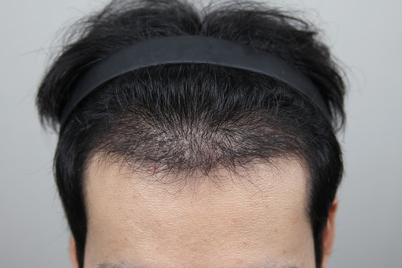 Single-person hospital, dermatologist Monara, 4 months after receiving Hair Transplant