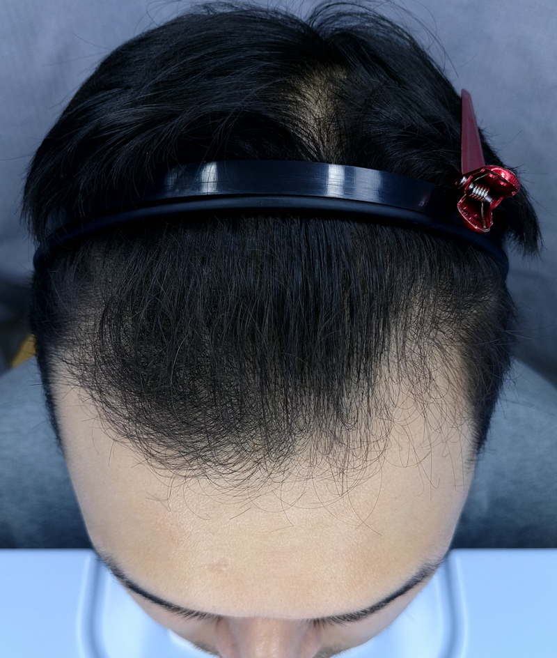 신재권 2800모 수술전3.PNG