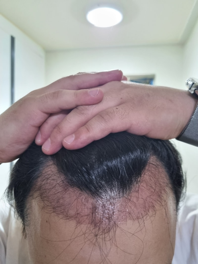 2000모낭 모발이식 3개월차