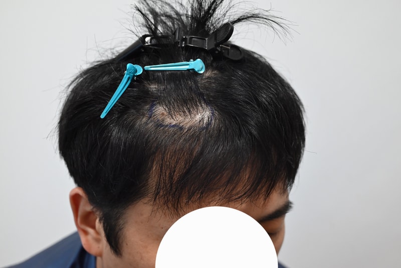 모발이식한달후기