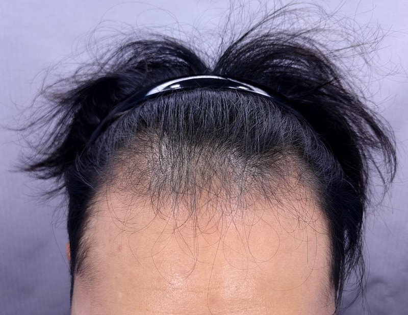 비절개 모발이식하고 9개월차 득모했습니다