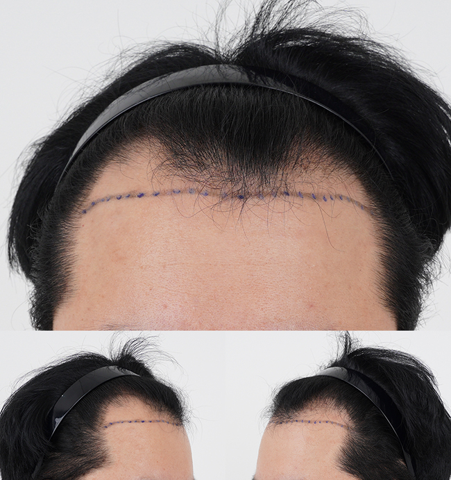 Daegu Department of Hair Loss in MOMO HAIR TRANSPLANT, Daegu, 10 months after surgery for 3800 Mo.