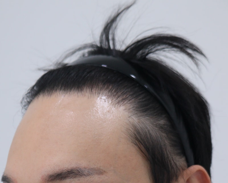 1. 수술전_2.JPG
