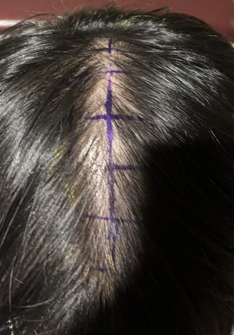 Late NEWHAiR Hair Transplant 1500 follicles, late 12-13 months.