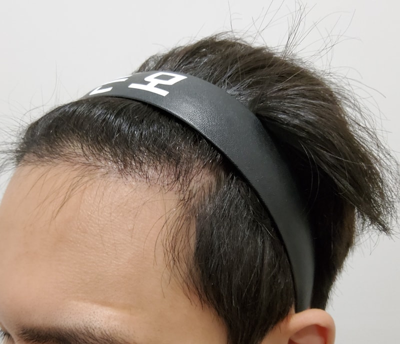 3. 수술후_6개월_2.jpg
