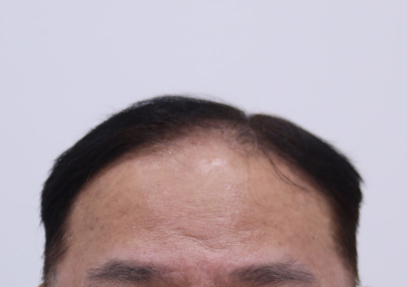 1. 수술전_1.JPG
