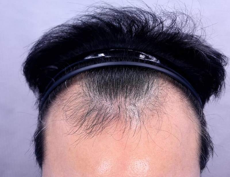 비절개모발이식 9개월경과 올립니다