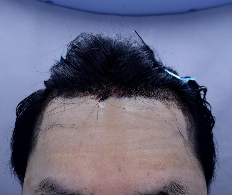 2. 수술후_1일_1.jpg