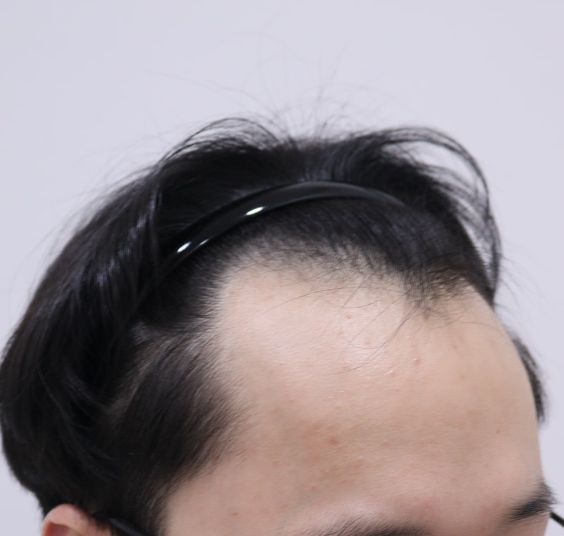 1. 수술전_2.JPG
