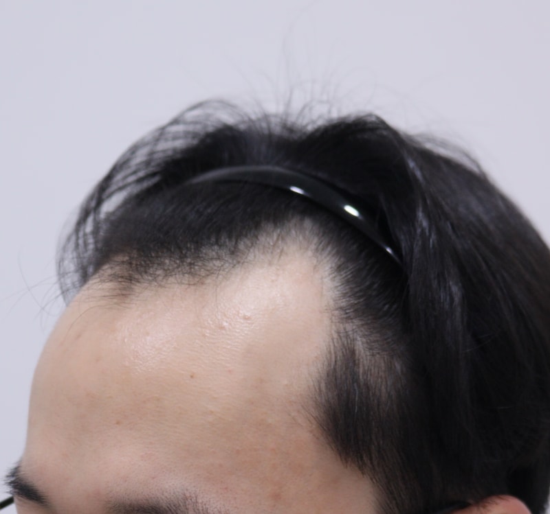 1. 수술전_3.JPG