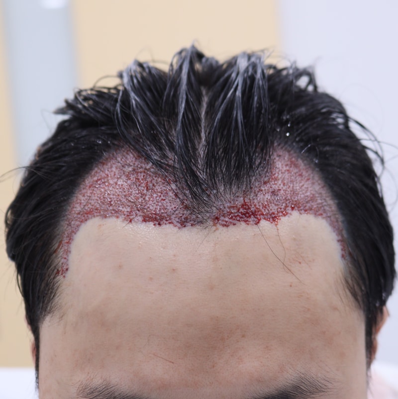2. 수술후_당일_1.JPG