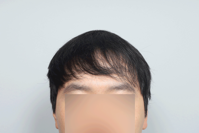 헤어라인 모발이식 1300모낭 무삭발 모원성형외과 1일차 후기입니다!
