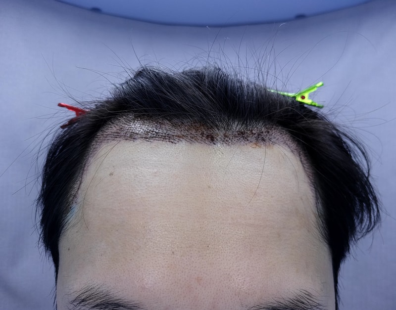 2. 수술후_1일_1.jpg