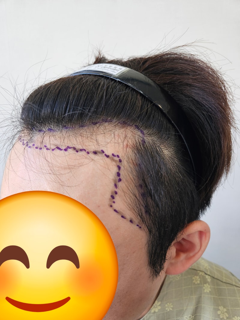 모발이식 받았습니다.