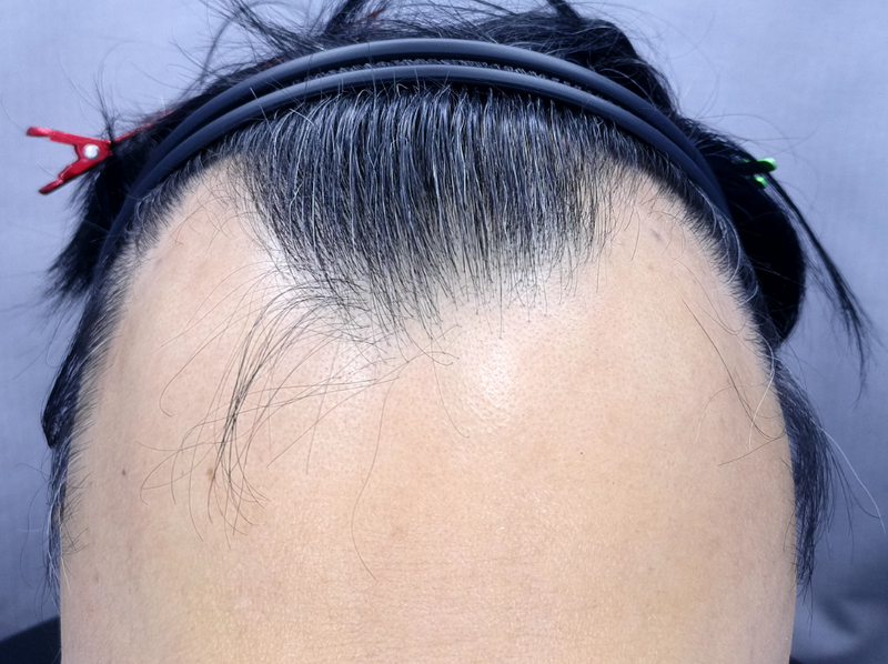 강충학88 3500모 이식전 정면.png