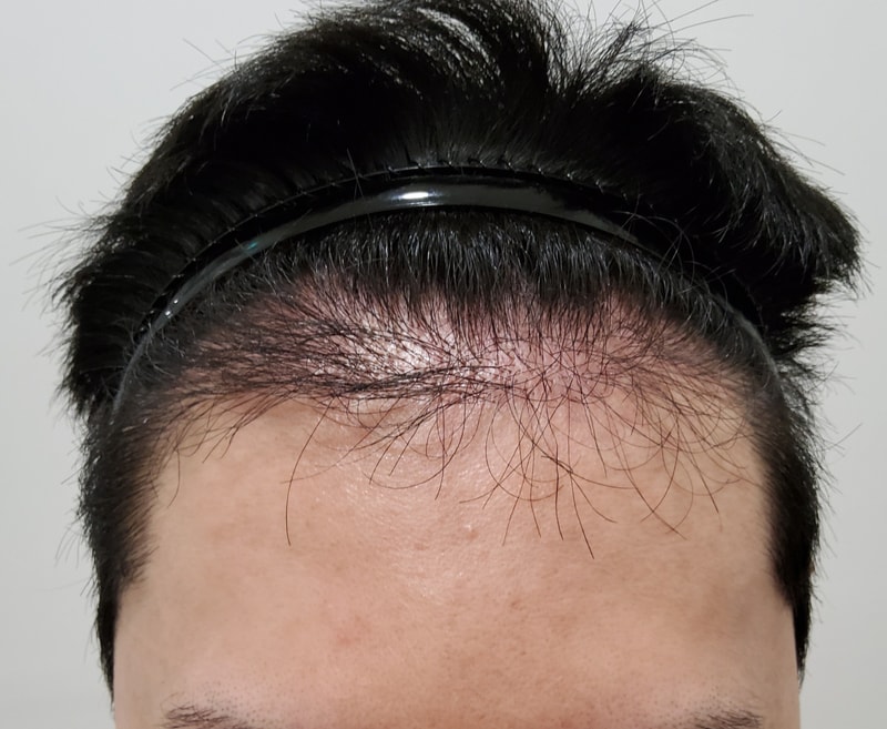 1년도 안되서 재이식하고 3개월