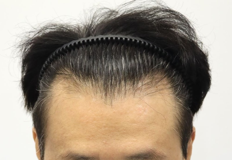 압구정 포헤어의원 50대 남자 M자탈모 비절개슬릿 모발이식 7개월 후기