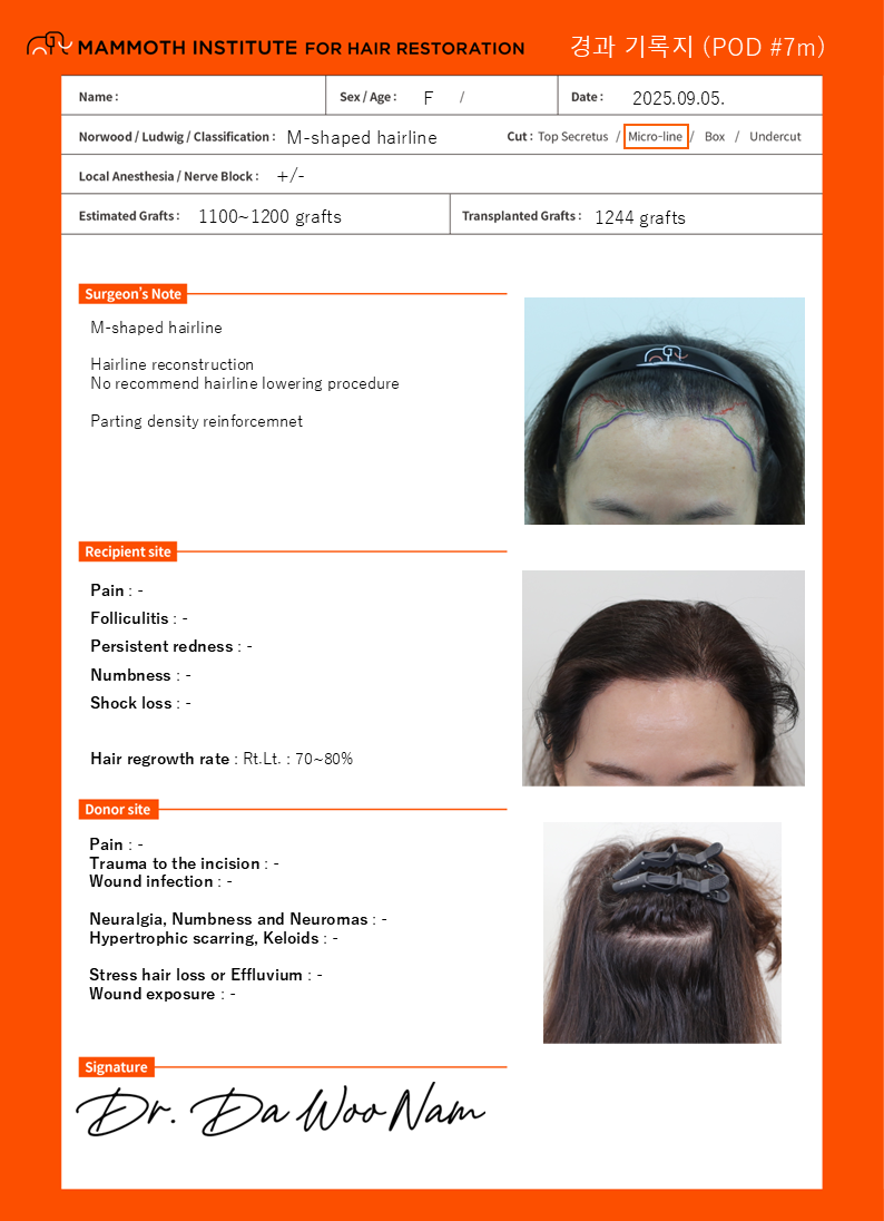 Apgujeong Mammoth's 7-month review of non-cut hair transplantation