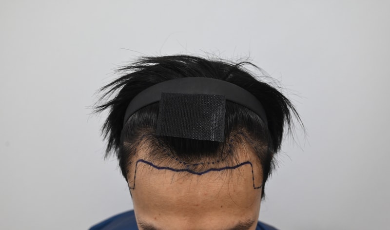 시술전 디자인1.jpg
