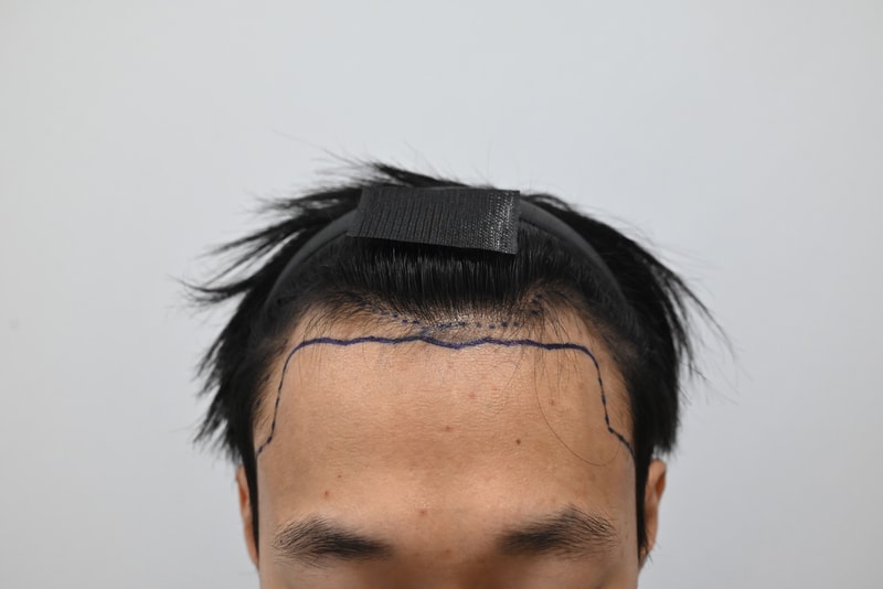 시술전 디자인2.jpg