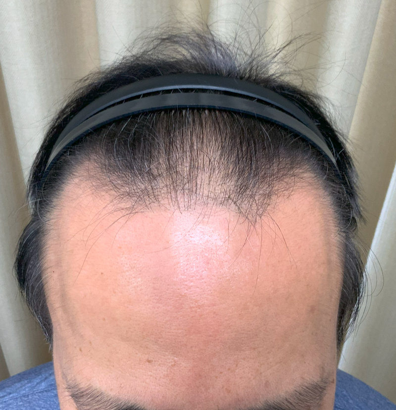 김형준67 4000모이식전.png