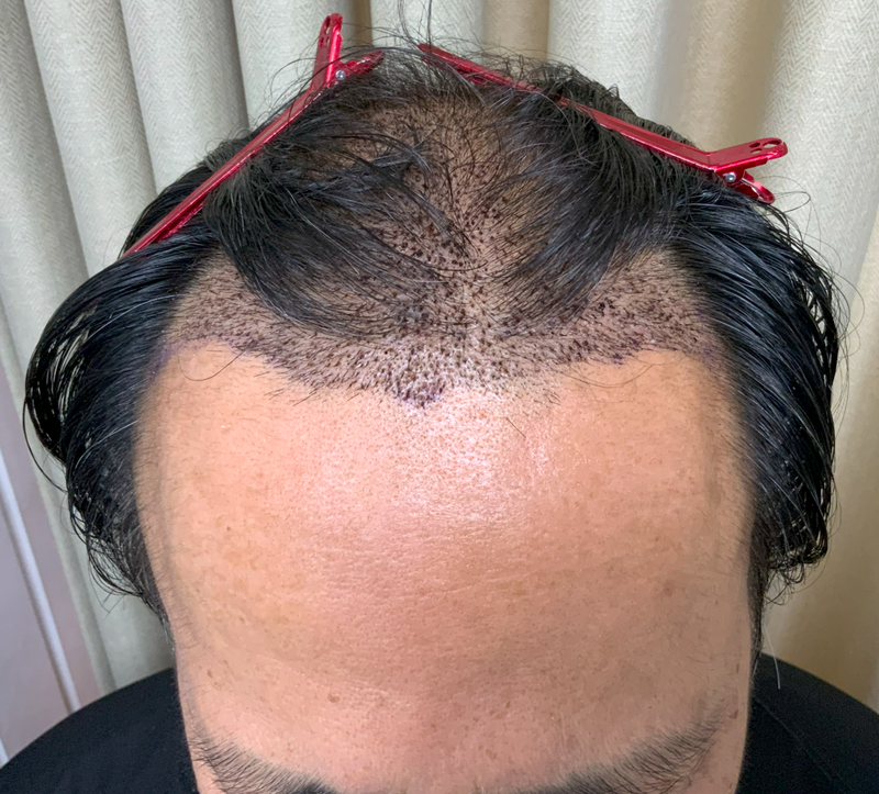 김형준67 4000모이식후.png