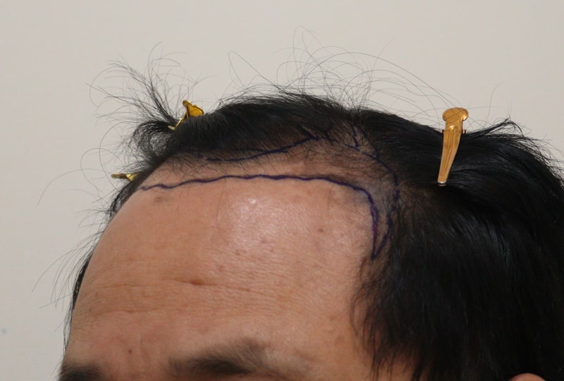 1. 수술전_3.JPG