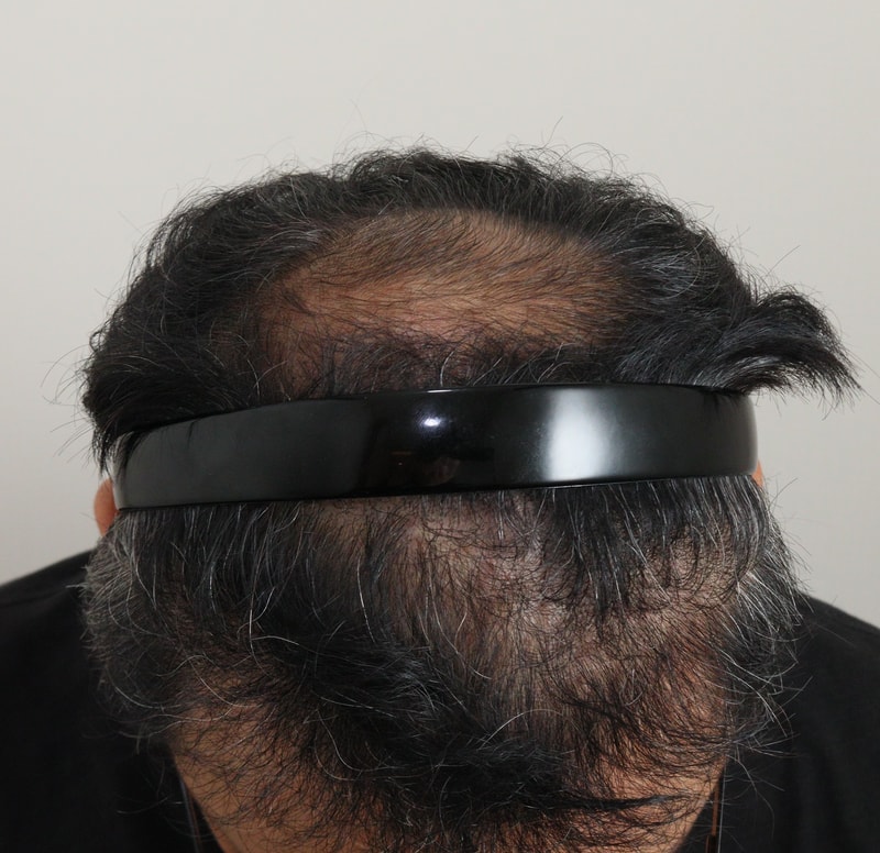 3. 수술후_6개월_2.JPG