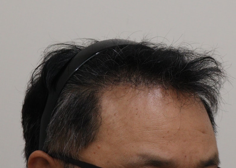 3. 수술후_6개월_4.JPG