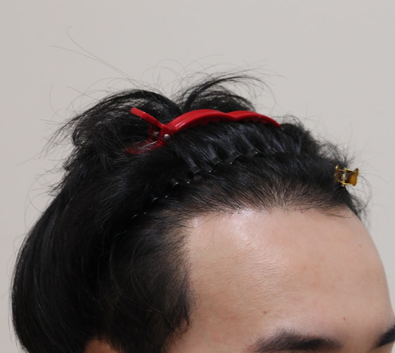 3. 수술후_6개월_4.JPG