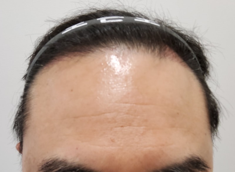 3. 수술후_3개월_1.jpg