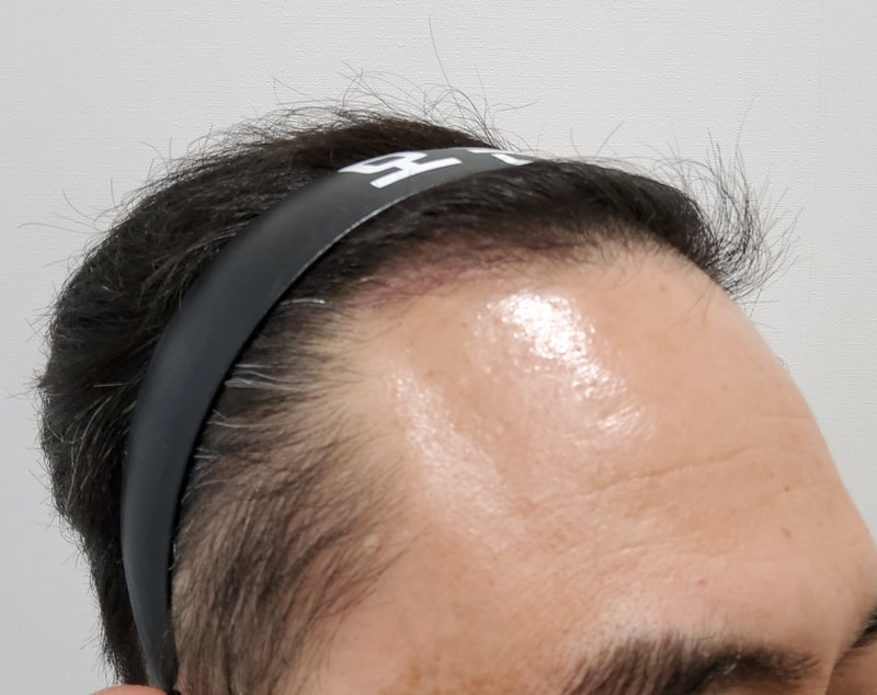 3. 수술후_3개월_3.jpg