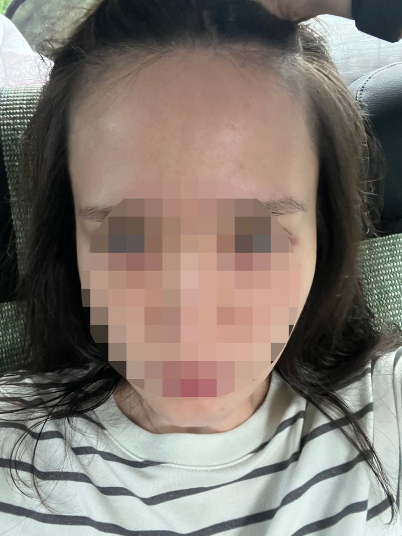  모원성형외과 헤어라인 1000모낭 모발이식 비절개방식 4개월차